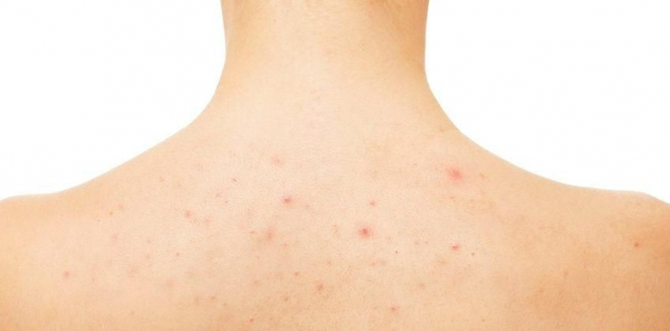 Ayurveda for back acne