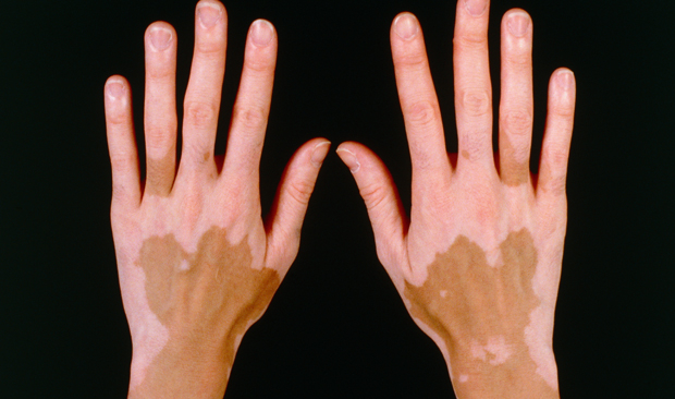 vitiligo